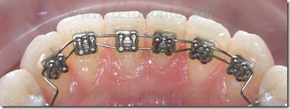 Restoration of a lower incisor's periodontal health by means of a ...